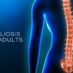 scoliosis in adults